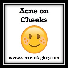 Prevent Acne on Cheeks with Ultimate Prolific Acne Recipe by Secret of Aging