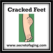 Cracked Feet by Secret of Aging! Alleviate Cracked Feet with daily use of Revitalizing Foot Cream!