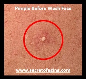 Blown Up Pimple Before Wash Face by Secret of Aging