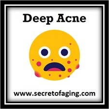 Deep Acne use this Ultimate Prolific Acne Recipe by Secret of Aging