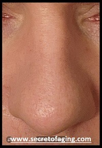 Large Pore Nose After Front View by Secret of Aging