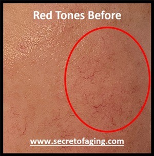 Red Tones with Acne by Secret of Aging