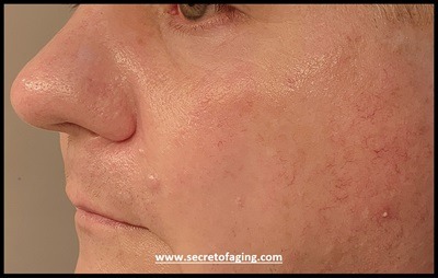 Ultimate Prolific Acne - Wrong Skincare by Secret of Aging