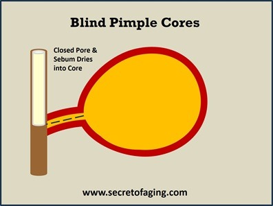 Also, Blind Pimple Cores Quickly with Ultimate Prolific Acne Recipe by Secret of Aging