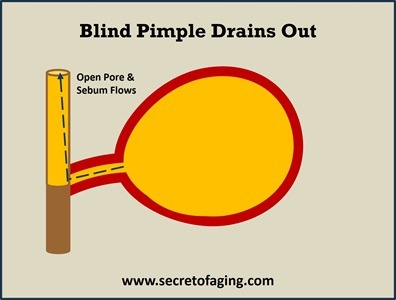 Blind Pimple Drains Out Quickly with Blind Pimple Recipe by Secret of Aging