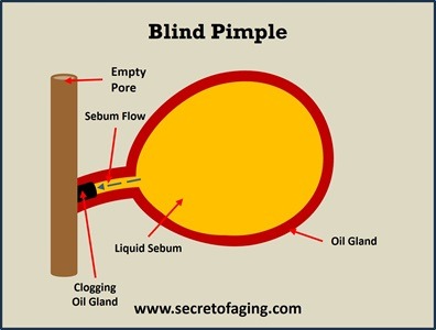 Use Blind Pimple Recipe by Secret of Aging