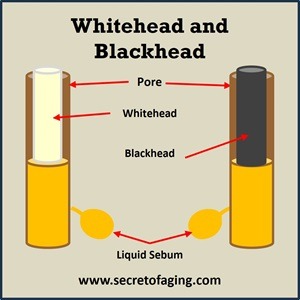 Whitehead and Blackhead by Secret of Aging