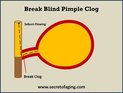 Break Blind Pimple Clog by Secret of Aging