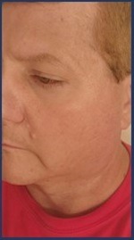 Before Bed Rosacea 08-08-2025 by Secret of Aging