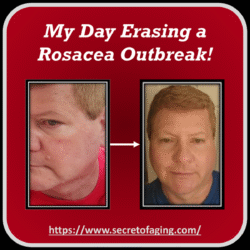 My Day Erasing a Rosacea Outbreak