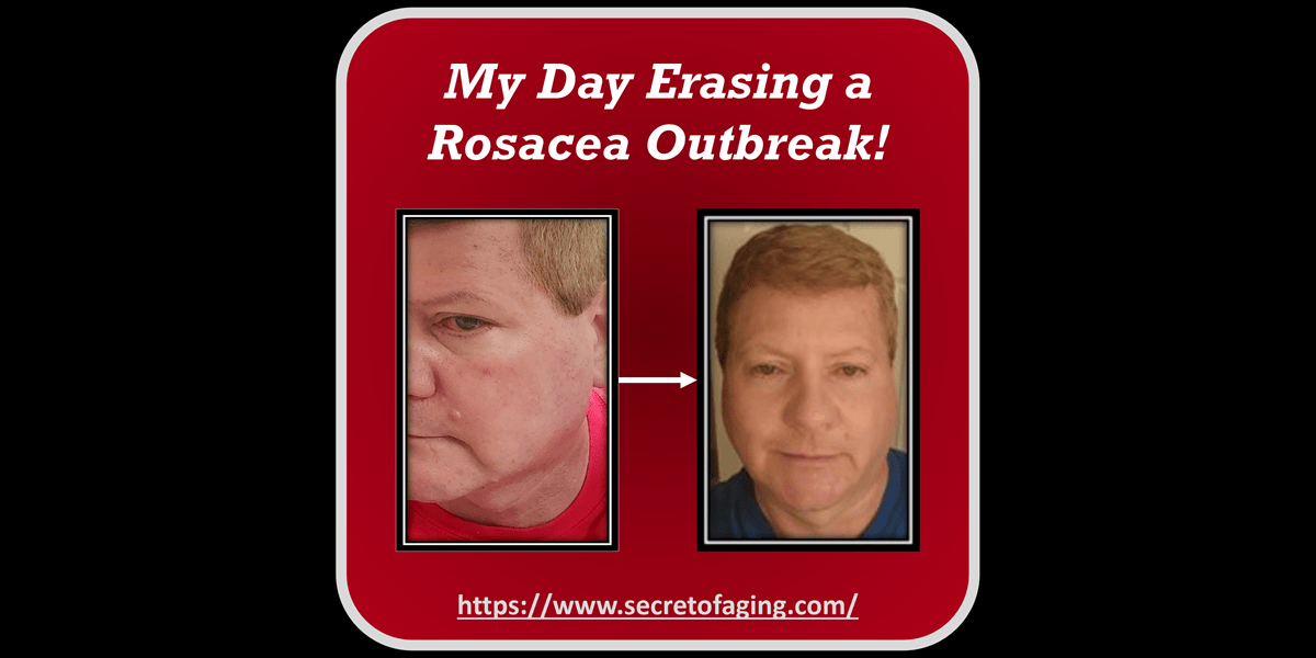 My Day Erasing a Rosacea Outbreak