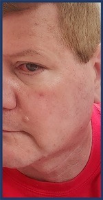 Woke Up with Rosacea 08-08-2025 by Secret of Aging