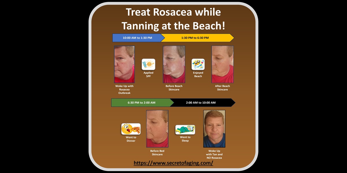 Treat Rosacea while Tanning at the Beach by Secret of Aging