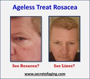 Ageless Treat Rosacea Image by Secret of Aging