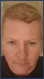 Rosacea with No Medicine or Makeup! 