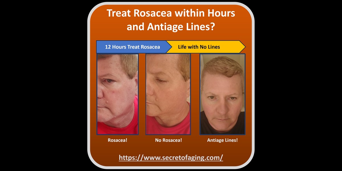 Treat Rosacea within Hours and Antiage Lines by Secret of Aging