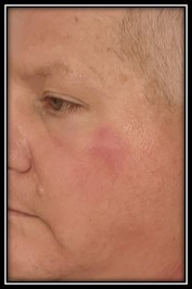 Dermatitis Outbreak Cropped Nov. 2025 by Secret of Aging
