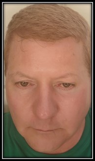Relieving Dermatitis with Rosacea Skincare Photo Dec 20. 2025 by Secret of Aging