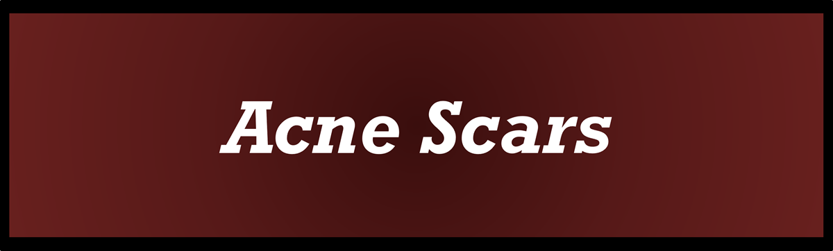 Acne Scars by Secret of Aging